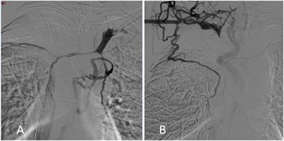 Superior Vena Cava (SVC) Endovascular Reconstruction with Implanted Central Venous Catheter Repositioning for Treatment of Malignant SVC Obstruction